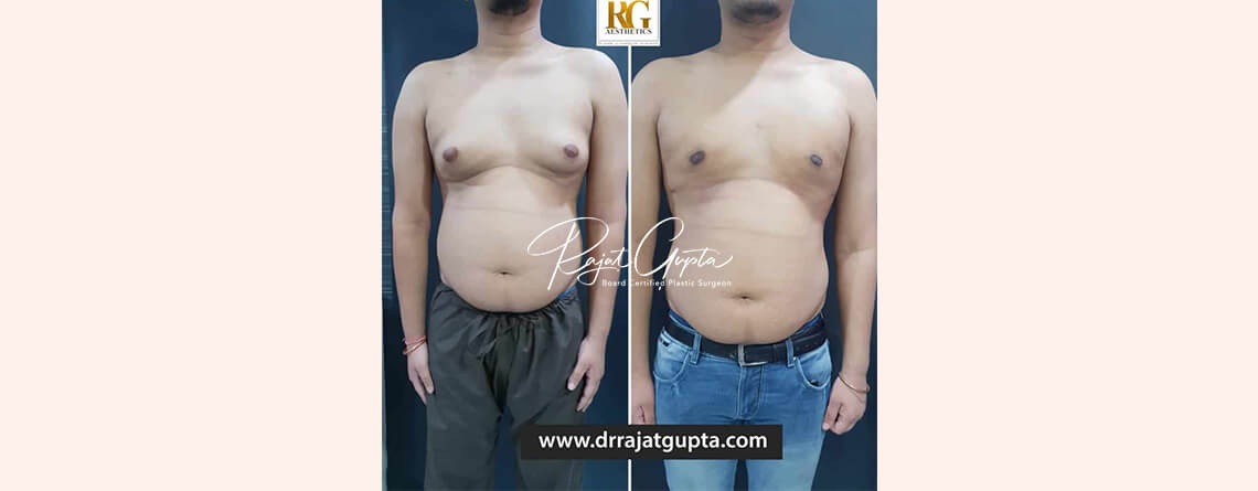 Dr Rajat Gupta gynecomastia Delhi
