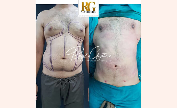 Gynecomastia Surgery before and after results