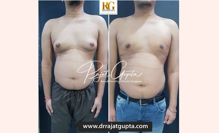 gynecomastia surgery before and after