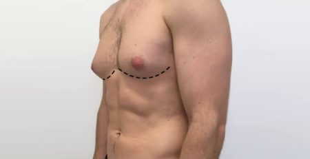gynecomastia surgery recovery Delhi