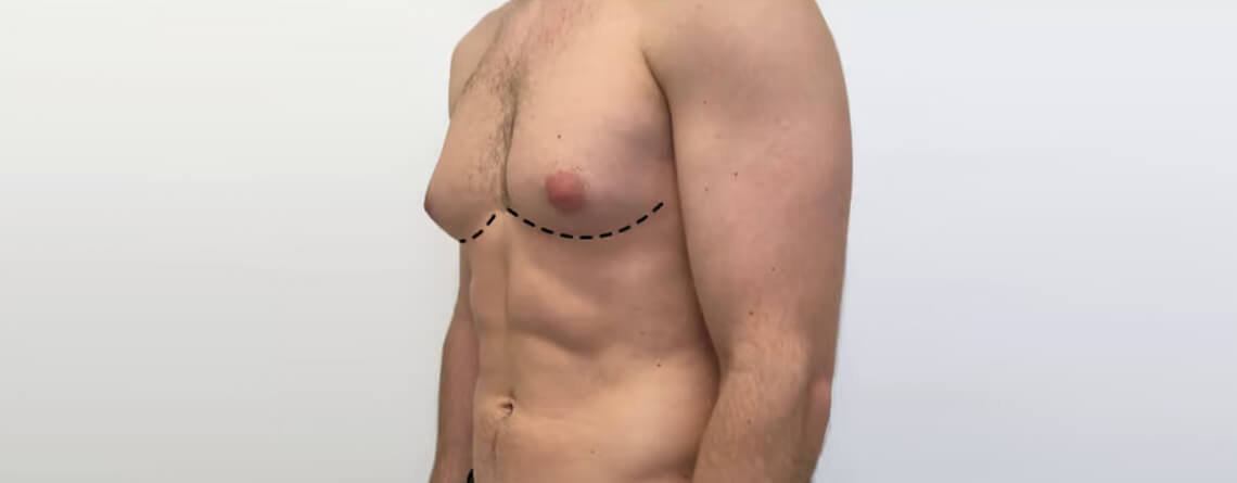 gynecomastia surgery recovery Delhi