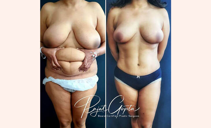 high definition abdominoplasty results