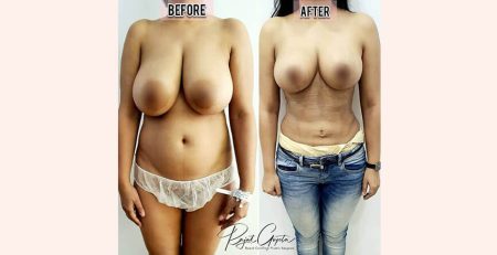 Who is the candidate RG flap breast reduction