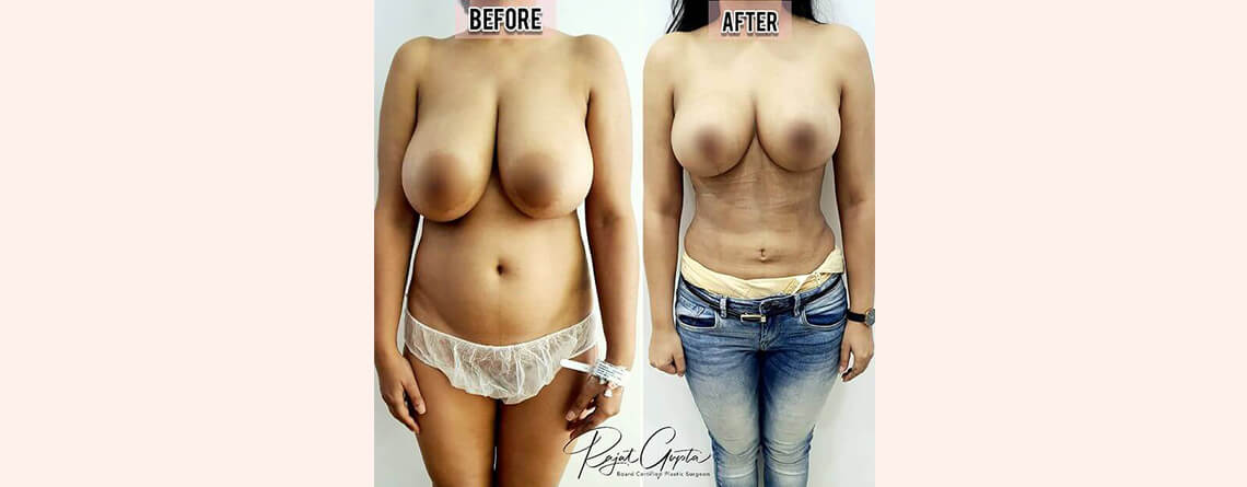 Who is the candidate RG flap breast reduction