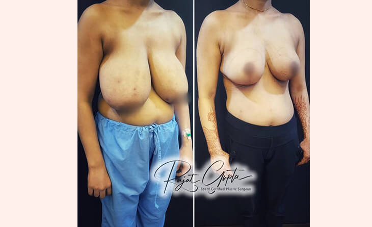 breast reduction surgery before and after