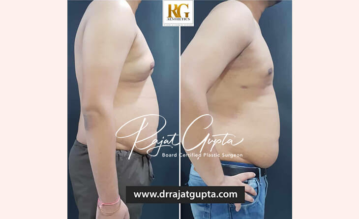 gynecomastia surgery before and after