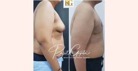 OCCULT technique gynecomastia surgery