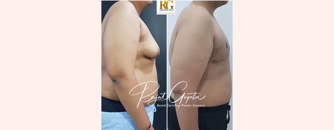 OCCULT technique gynecomastia surgery