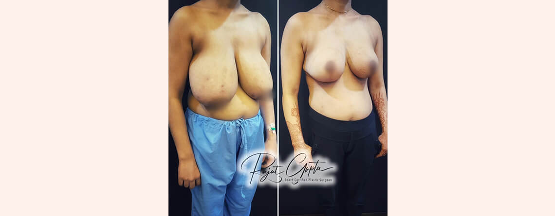 RG flap natural lift breast reduction