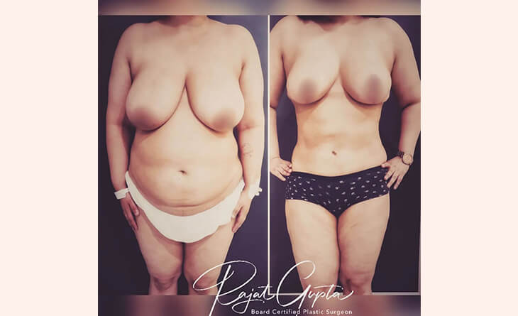 breast reduction surgery before and after