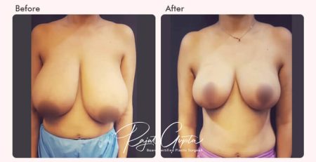 breast reduction surgery before and after