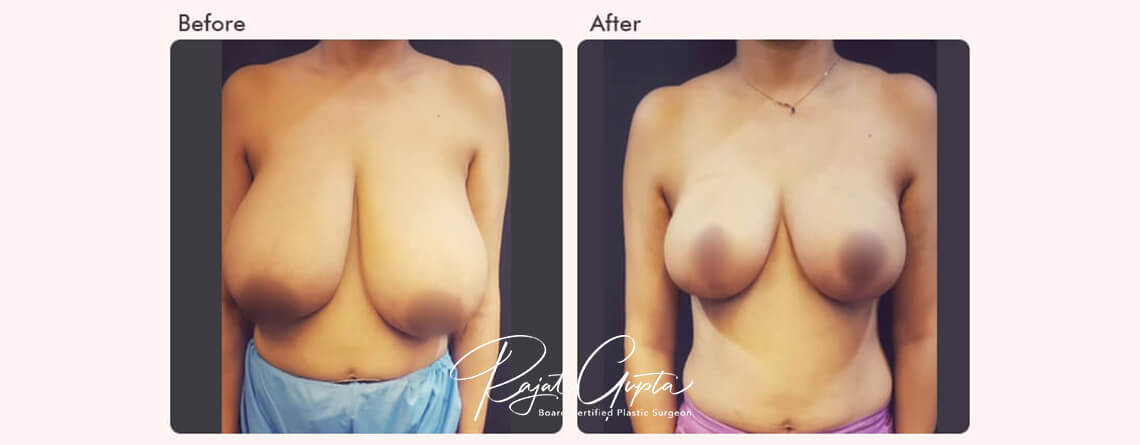 breast reduction surgery before and after