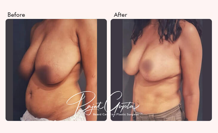 RG flap breast reduction Delhi