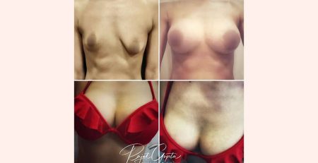 Breast Augmentation in Delhi