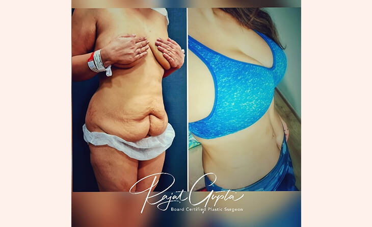Breast Augmentation before and after