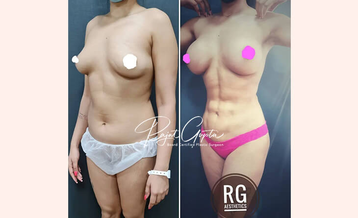 Liposuction Surgery before and after
