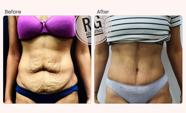 Liposuction Surgery Cost in Delhi