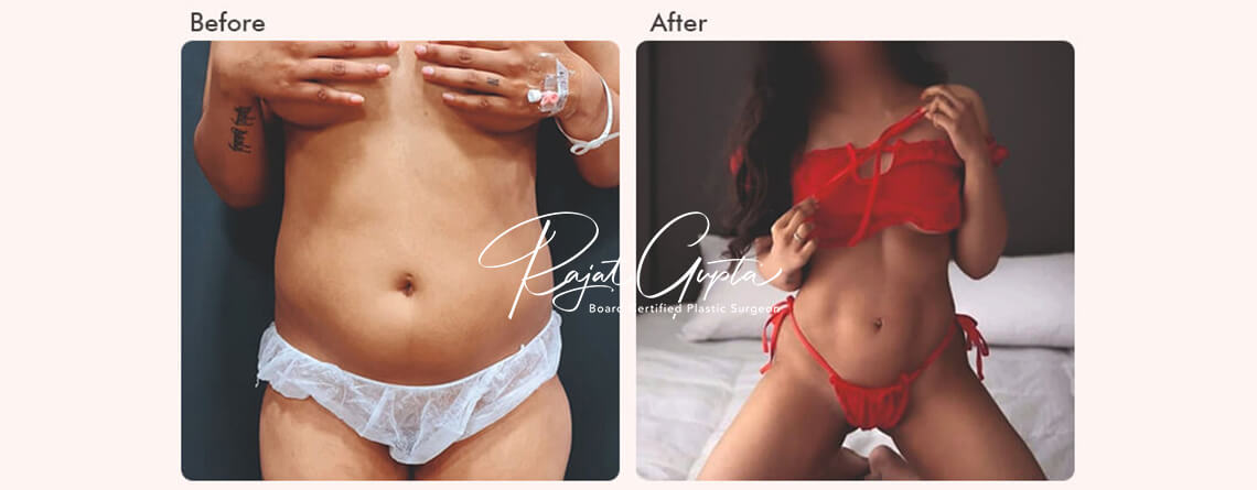 Liposuction Surgery Before and After