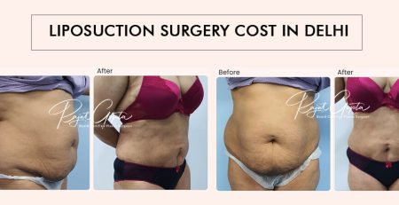 Liposuction Surgery Cost in Delhi