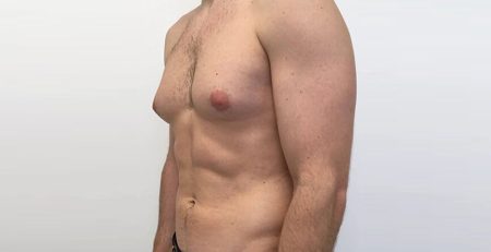 Gynecomastia Surgery