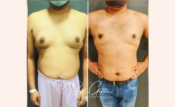 OCCULT Technique Is Changing Gynecomastia Surgery - Dr Rajat Gupta - Cosmetic surgeon in Delhi -02 Gynecomastia Surgery before and after