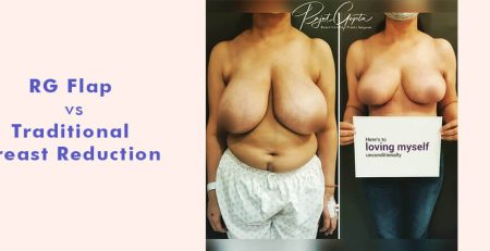 RG flap vs traditional breast reduction