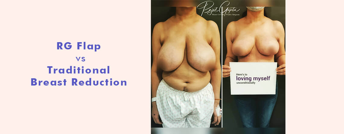 RG flap vs traditional breast reduction
