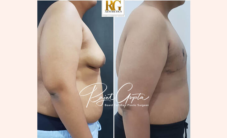 Gynecomastia Surgery Before and After Result