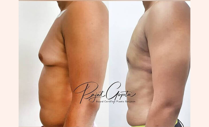 gynecomastia surgery before and after - Dr rajat gupta - RG aesthetics Gynecomastia Surgery cost in Delhi