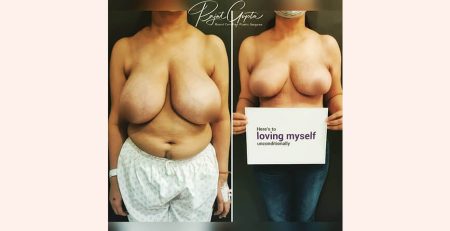 Breast Lift Surgery in Delhi