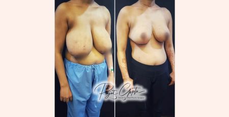 Breast Reduction Surgery