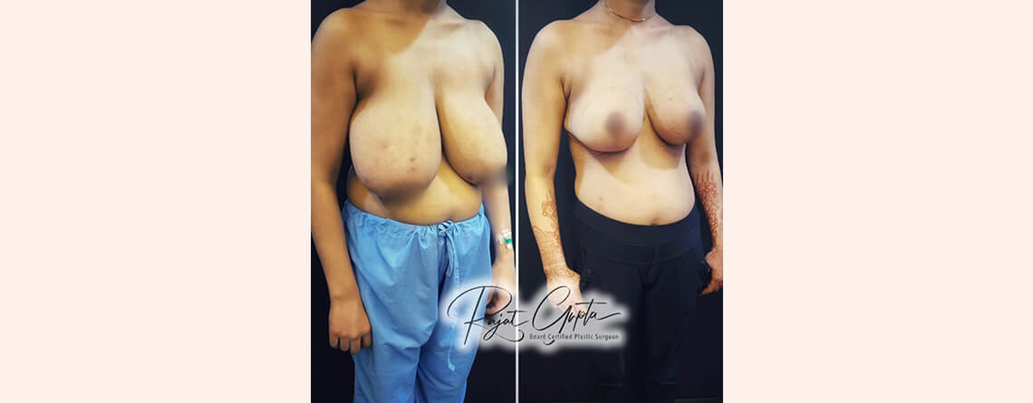 Breast Reduction Surgery