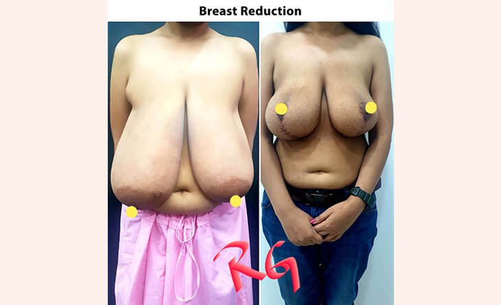 Breast Reduction Surgery Before And After