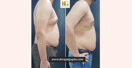 How is Scarless Gynecomastia Surgery Possible in India By Dr Rajat Gupta Plastic Surgeon - RG Aesthetics