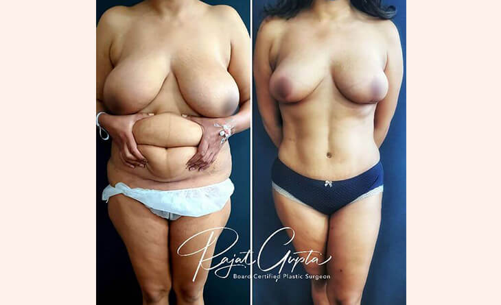 Lipoabdominoplasty Before After Results - High-Definition Abdominoplasty- RG Aesthetics Lipoabdominoplasty Before After Results - High-Definition Abdominoplasty- RG Aesthetics