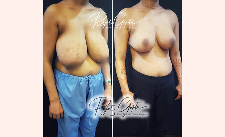 RG Flap Technique Surgery vs Other Breast Reduction Methods - Dr Rajat Gupta - Best Breast Reduction Surgeon in India - RG Aesthetics RG Flap Technique Surgery