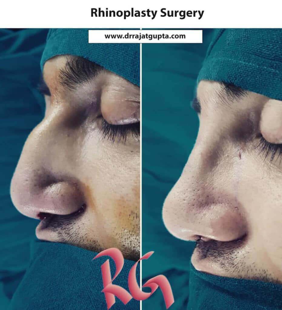 Rhinoplasty-Surgery-Before-After-Image-02-931x1024-1 Rhinoplasty Surgery Before and After