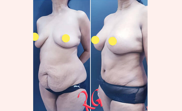 Tummy Tuck Before After Results - High-Definition Abdominoplasty- Dr Rajat Gupta - RG Aesthetics Tummy Tuck Before After Results - High-Definition Abdominoplasty- Dr Rajat Gupta - RG Aesthetics