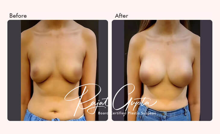Breast Augmentation Surgery Financing Options in India - Breast Augmentation Results - Dr Rajat Gupta Breast Augmentation Surgery Financing Options in India - Breast Augmentation Results - Dr Rajat Gupta