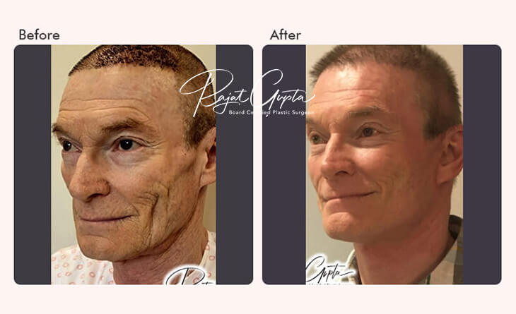 Facelift Surgery Before and After - Facelift Surgery in Delhi - Dr Rajat Gupta - Plastic Surgeon in Delhi Facelift Surgery Before and After - Facelift Surgery in Delhi - Dr Rajat Gupta - Plastic Surgeon in Delhi