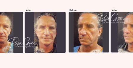 Facelift Surgery in Delhi India - Facelift Surgery Clinic in India - Dr Rajat Gupta - Plastic Surgeon in Delhi