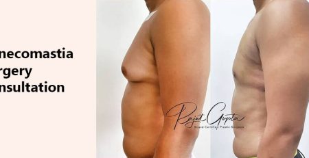 Gynecomastia Surgery Consultation - Gynecomastia Surgery in Delhi - Dr Rajat Gupta