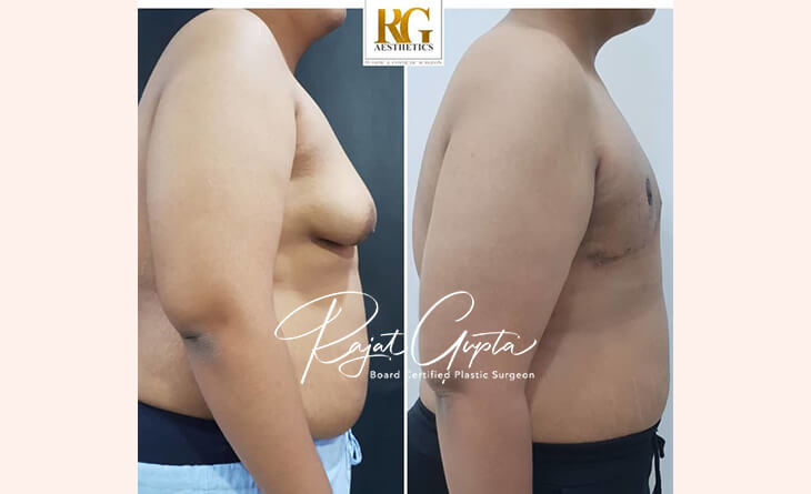 Gynecomastia Surgery Consultation - Gynecomastia Surgery in Delhi - Dr Rajat Gupta - RG Aesthetics Gynecomastia Surgery Consultation - Gynecomastia Surgery in Delhi - Dr Rajat Gupta - RG Aesthetics