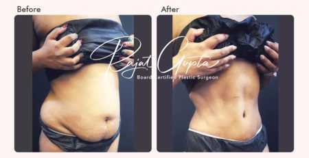 Latest Tummy Tuck Surgery Techniques - Dr Rajat Gupta - Plastic Surgeon in Delhi