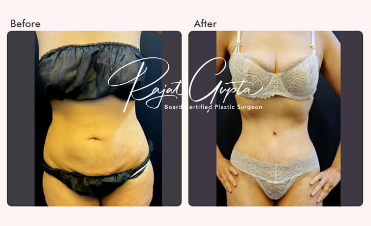 Latest Tummy Tuck Surgery Techniques - Dr Rajat Gupta - Plastic Surgeon in Delhi - RG Aesthetics Latest Tummy Tuck Surgery Techniques - Dr Rajat Gupta - Plastic Surgeon in Delhi - RG Aesthetics
