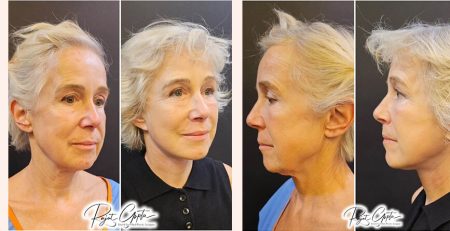 Schedule Facelift Surgery Consultation - Facelift surgery before and after - Dr Rajat Gupta - Plastic Surgeon in Delhi