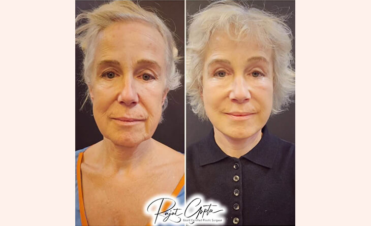 Schedule Facelift Surgery Consultation - Facelift surgery before and after - Dr Rajat Gupta Schedule Facelift Surgery Consultation - Facelift surgery before and after - Dr Rajat Gupta