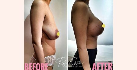 Breast Lift in Delhi