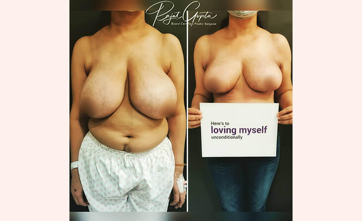 Breast Lift Scars- Breast Lift surgery before and after Breast Lift surgery before and after