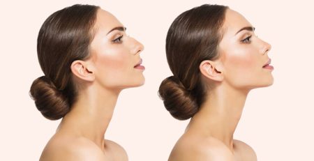 How Long Does a Nose Job Take to Heal - Rhinoplasty Surgery in Delhi